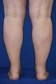 Ankles & Calves Liposuction
