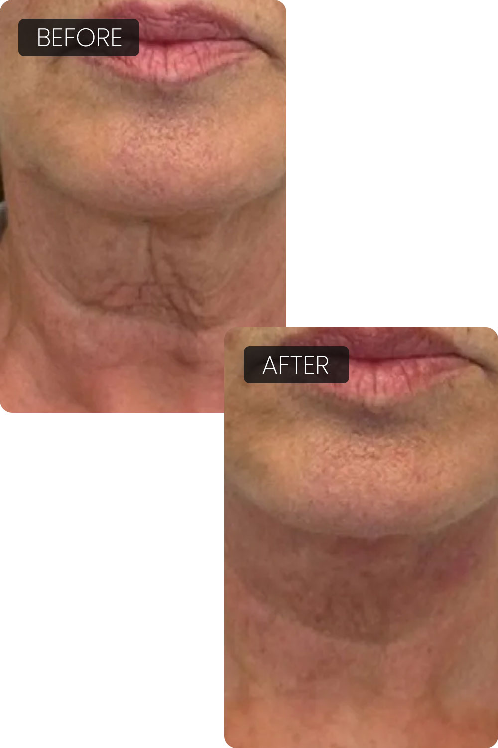 EndoliftX® results
