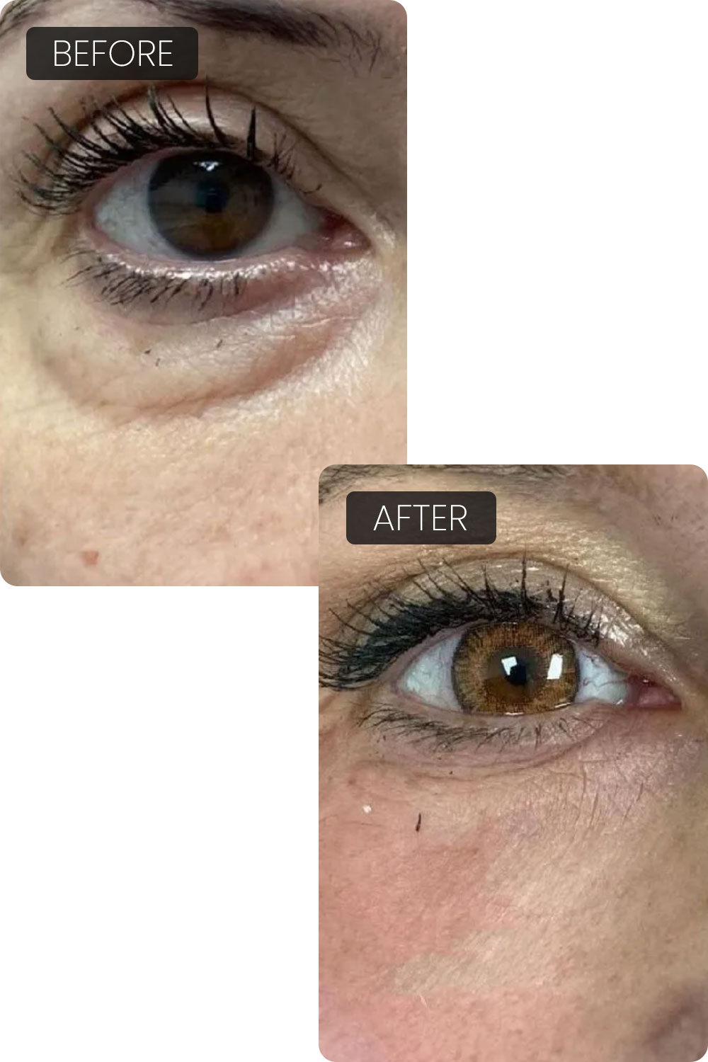 EndoliftX® results