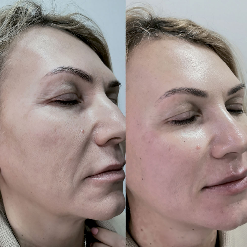 Jalupro® – Skin Hydration and Rejuvenation