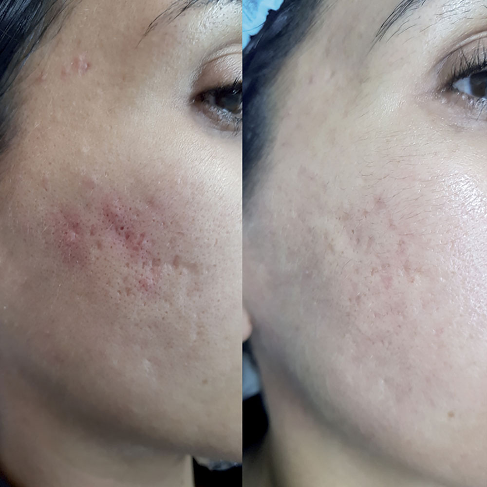 Jalupro® – Skin Hydration and Rejuvenation