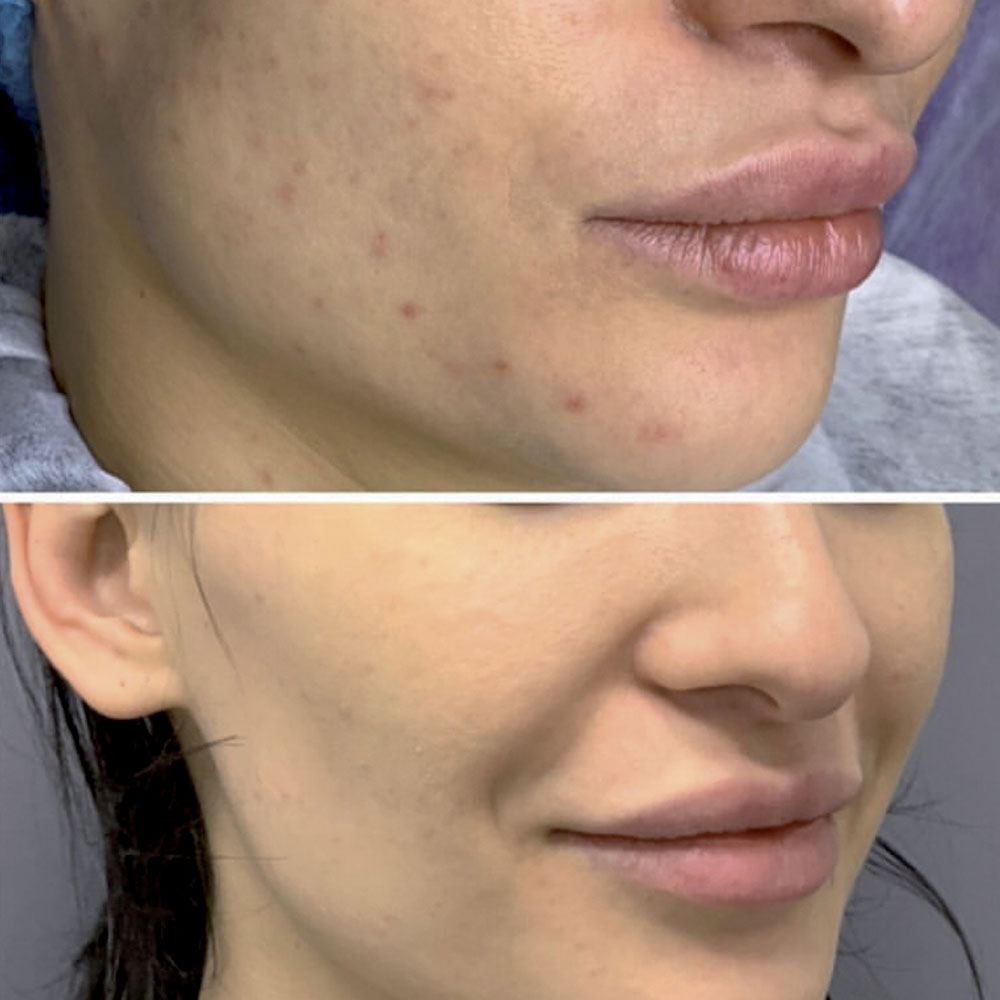 Jalupro® – Skin Hydration and Rejuvenation