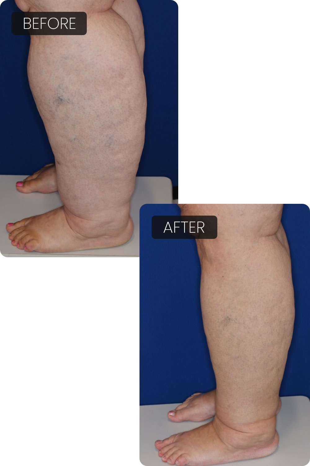 Lipodema - before and after imagery