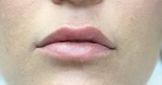 Dermal Fillers - lips
