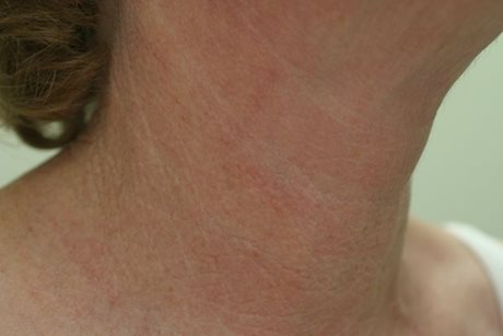 After Image of M22™ IPL photo rejuvenation