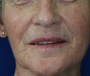 After Image of M22™ IPL photo rejuvenation