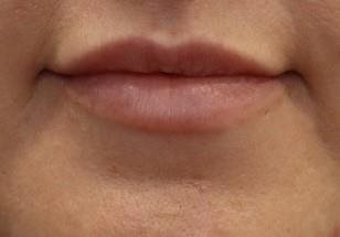 After Image of Dermal Filler - lips