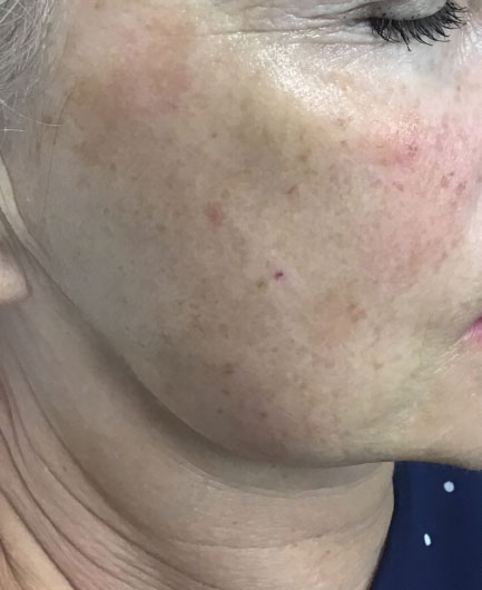 Before Image of M22™ IPL photo rejuvenation
