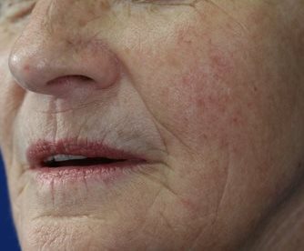 After Image of M22™ IPL photo rejuvenation