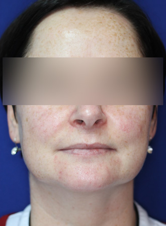 Before Image of M22™ IPL photo rejuvenation