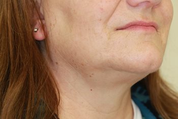 After Image of Dermal Fillers lower face