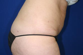 After Image of Abdomen Liposuction