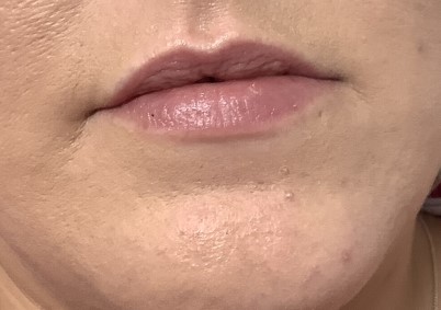 Before Image of Dermal Filler - lips