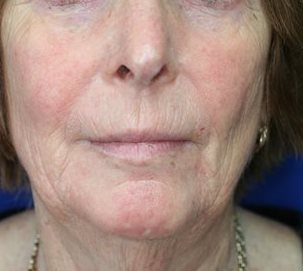 After Image of M22™ IPL photo rejuvenation