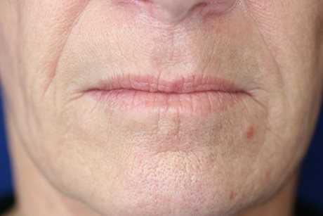 After Image of Dermal Fillers