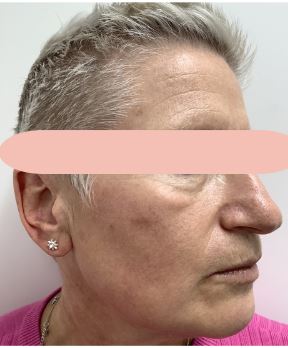 After Image of M22™ IPL photo rejuvenation