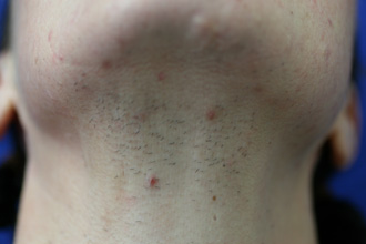 Before Image of Hair Removal