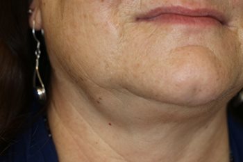 Before Image of Dermal Fillers lower face