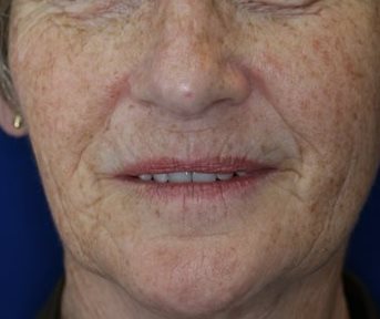 Before Image of M22™ IPL photo rejuvenation