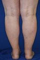 Ankles & Calves Liposuction