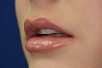 After Image of Dermal Fillers