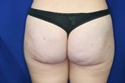 Buttocks Liposuction