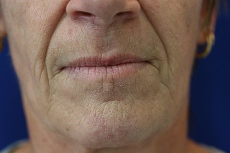 Before Image of Dermal Fillers