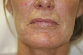 After Image of Lower face