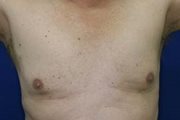 Male Breasts Liposuction