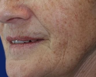 Before Image of M22™ IPL photo rejuvenation