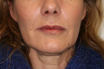 After Image of Dermal Fillers