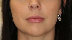 After Image of Dermal Fillers - lips