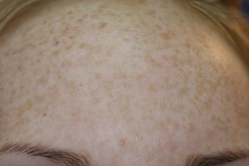 Before Image of M22™ IPL photo rejuvenation
