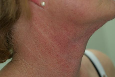 Before Image of M22™ IPL photo rejuvenation
