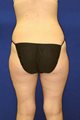 Outer Thighs Liposuction