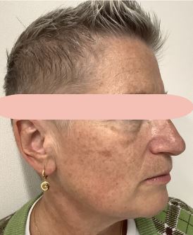Before Image of M22™ IPL photo rejuvenation