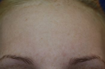 After Image of M22™ IPL photo rejuvenation