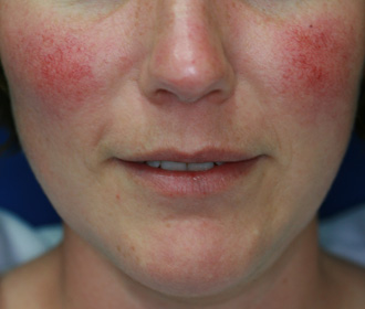 Before Image of M22™ IPL photo rejuvenation