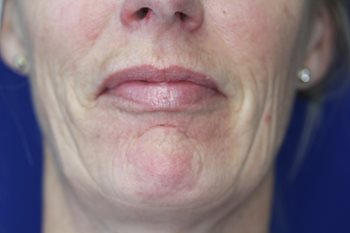 Before Image of Lower face