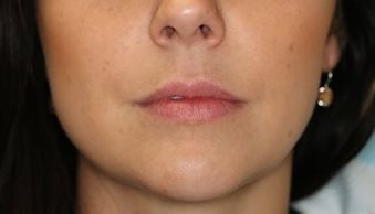 Before Image of Dermal Fillers - lips