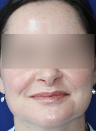 After Image of M22™ IPL photo rejuvenation