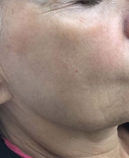 After Image of M22™ IPL photo rejuvenation