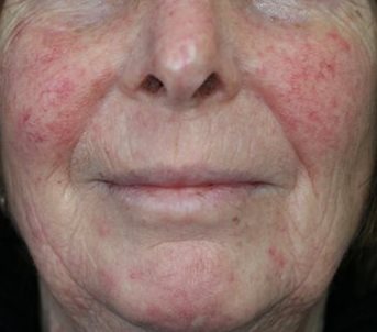 Before Image of M22™ IPL photo rejuvenation