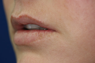 Before Image of Dermal Fillers