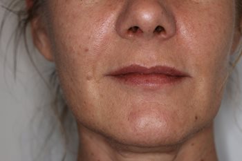 Before Image of Dermal Fillers