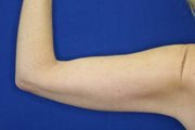 Upper Arms Liposuction